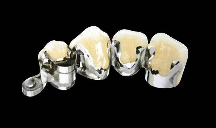 鈷鉻合金烤瓷牙材質(zhì)的優(yōu)劣點(diǎn)分析