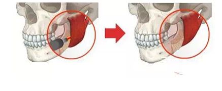 咬肌切除手術(shù)風(fēng)險(xiǎn)大么