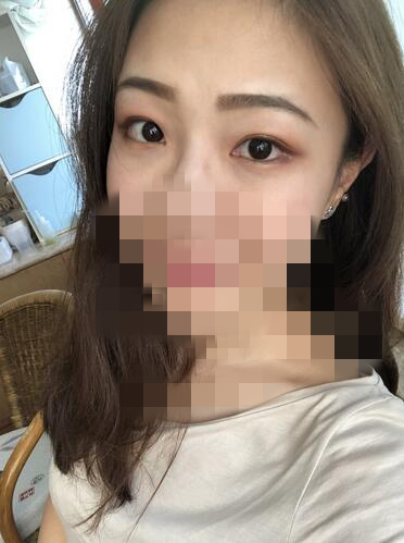 谷琪醫(yī)生-簡介資料-附內(nèi)切法祛眼袋案例