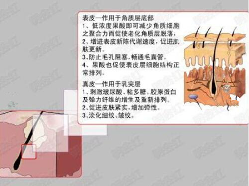 什么是果酸換膚