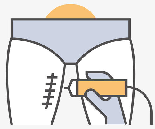 提臀瘦腿這個(gè)方法真的很管用：吸脂手術(shù)