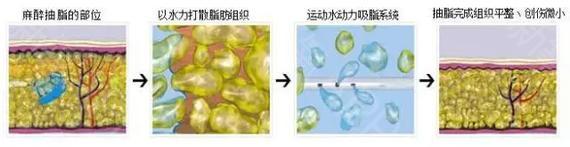 提臀瘦腿這個(gè)方法真的很管用：吸脂手術(shù)