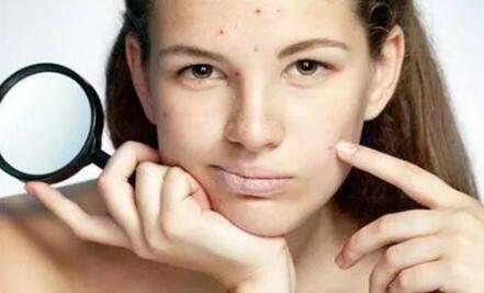 水楊酸祛痘果好嗎？原理和優(yōu)缺點(diǎn)解析！