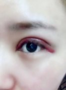 【案例】全切雙眼皮手術(shù)恢復(fù)的全過程，記錄起來