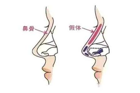 假體隆鼻手術(shù)沒(méi)問(wèn)題嗎?