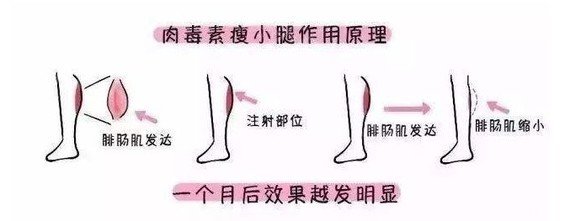 注射瘦腿有用嗎