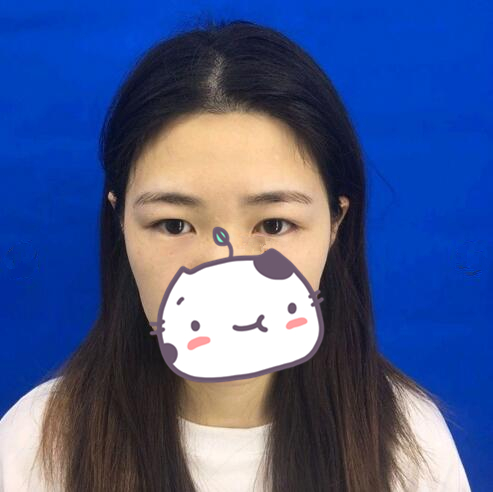 伊美爾雙眼皮案例