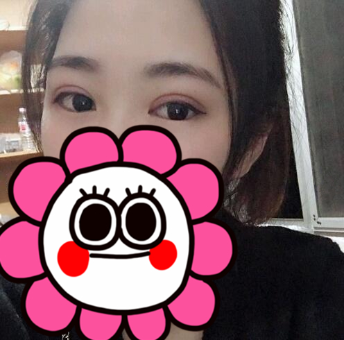 伊美爾雙眼皮案例