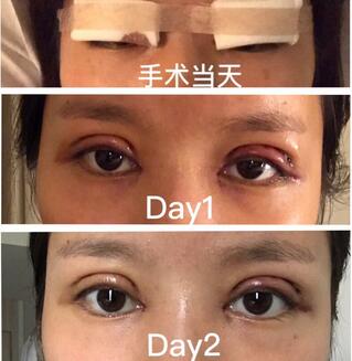 合肥105整形案例