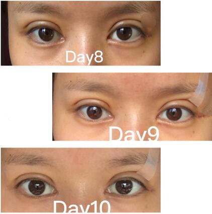 合肥105整形案例