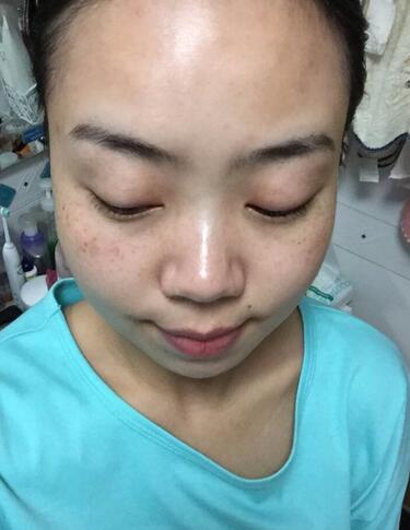 案例手術(shù)后介紹