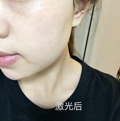 案例手術(shù)后介紹