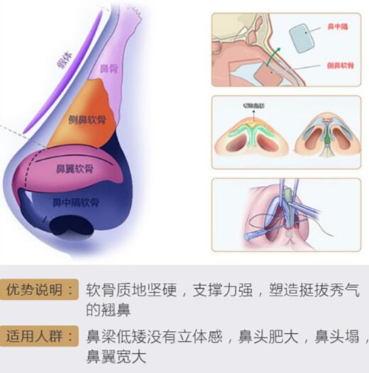 自體軟骨移植隆鼻術(shù)沒(méi)問(wèn)題嗎？揭開(kāi)手術(shù)真相的面紗……