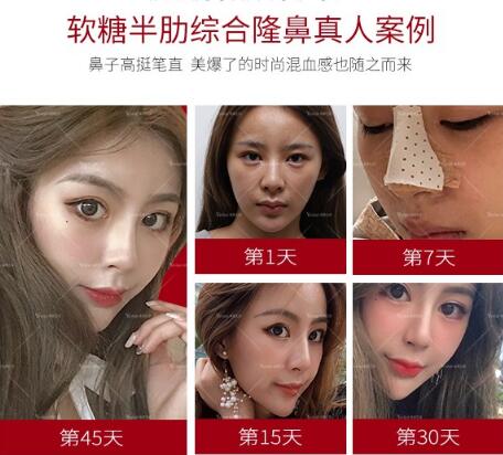 自體軟骨移植隆鼻果圖