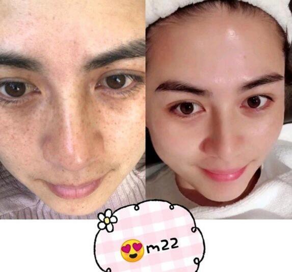 黃褐斑怎么消除