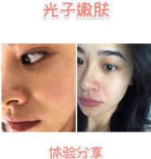 林秋蓉醫(yī)生做光子嫩膚體驗(yàn)過(guò)程心得分享 嫩如布?。?></a>
								</div>
								<div   id=