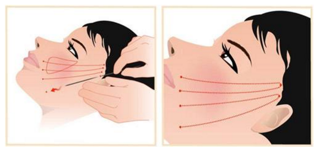 電波拉皮手術(shù)費用