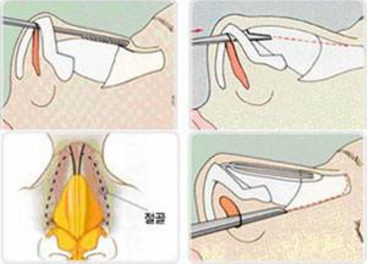 駝峰鼻整形一定要磨鼻梁骨嗎？鼻型不一定要一定筆直！