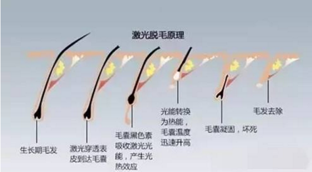 怎樣才能長(zhǎng)期性脫毛
