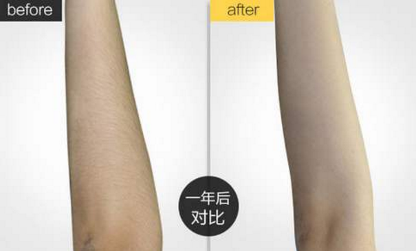 怎樣才能長(zhǎng)期性脫毛