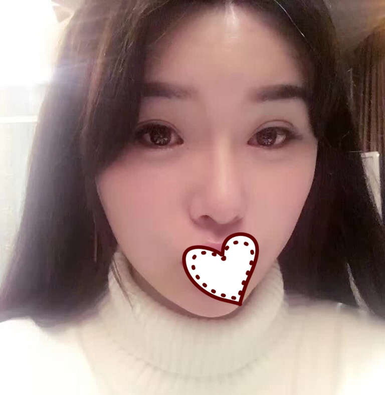 鼻骨縮窄手術果