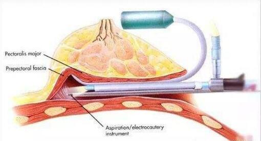 做假體隆胸手術(shù)沒(méi)問(wèn)題嗎