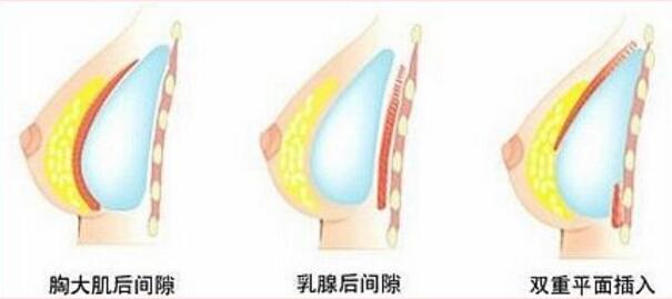 做假體隆胸手術(shù)沒(méi)問(wèn)題嗎