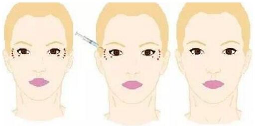 天生魚尾紋做什么手術(shù)去除好？