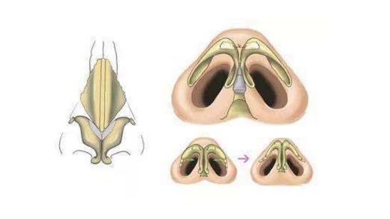 怎么讓鼻頭縮小