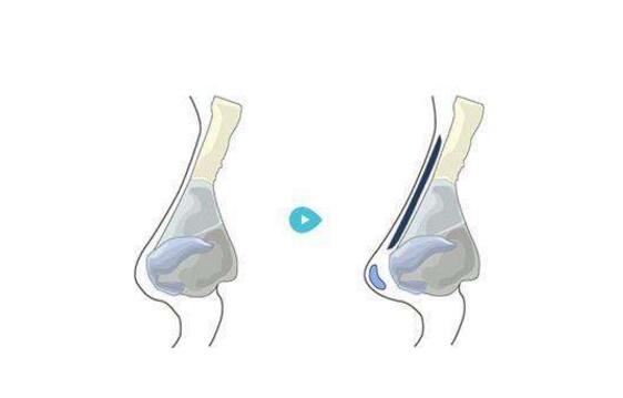 怎么讓鼻頭縮小