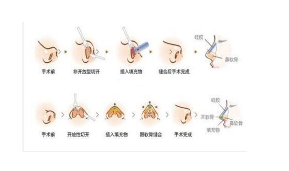 怎么讓鼻頭縮小