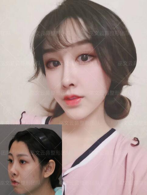 巫文云隆鼻修復(fù)案例