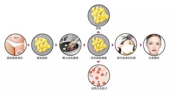 自體脂肪填充果能夠長期保存主要看這些因素