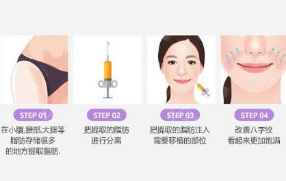 這些玻尿酸注射法令紋沒問題要點一定要記住