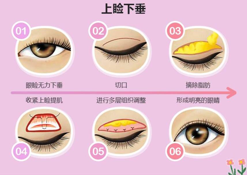 眼睛無論怎么睜開都不大