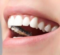 大連牙齒美容整形哪家醫(yī)院好 地包天矯正價(jià)格貴不