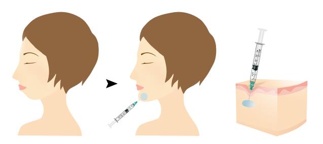 整形墊下巴做的好