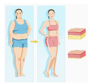 這個吸脂層次要做的好了