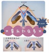 大鼻頭整形做的好 氣質(zhì)提高了不止一個檔次