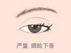 杭州芭黎雅整形醫(yī)院上瞼下垂矯正術(shù)果 還你迷人明眸