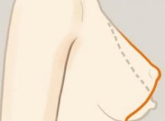 汕頭華美整形醫(yī)院乳房下垂矯正有哪些優(yōu)點 還會下垂嗎