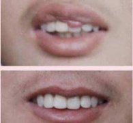 北京京民整形醫(yī)院重唇整形需要多少錢 果怎么樣啊