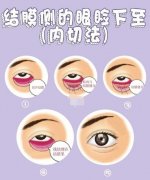 這種形狀的眼瞼下垂要針對調(diào)節(jié) 你屬于這種癥狀嗎