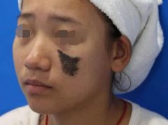 深圳景田醫(yī)院整形科激光去胎記的優(yōu)點 去除胎記不留尷尬