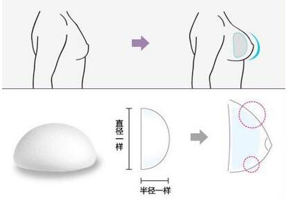這樣子做隆胸手術(shù)