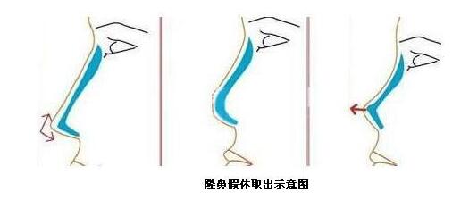 隆鼻假體取出后你的鼻子會(huì)變成這樣子