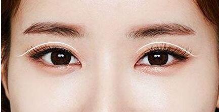 能割成三眼皮四眼皮都是這些致命細(xì)節(jié)沒有注意到