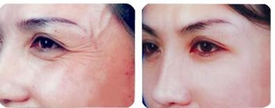 魚尾紋的四個(gè)等級(jí)