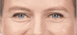 魚尾紋的四個(gè)等級(jí)