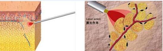 科普：醫(yī)美中各種各樣的減肥方法看看哪一種適合自己